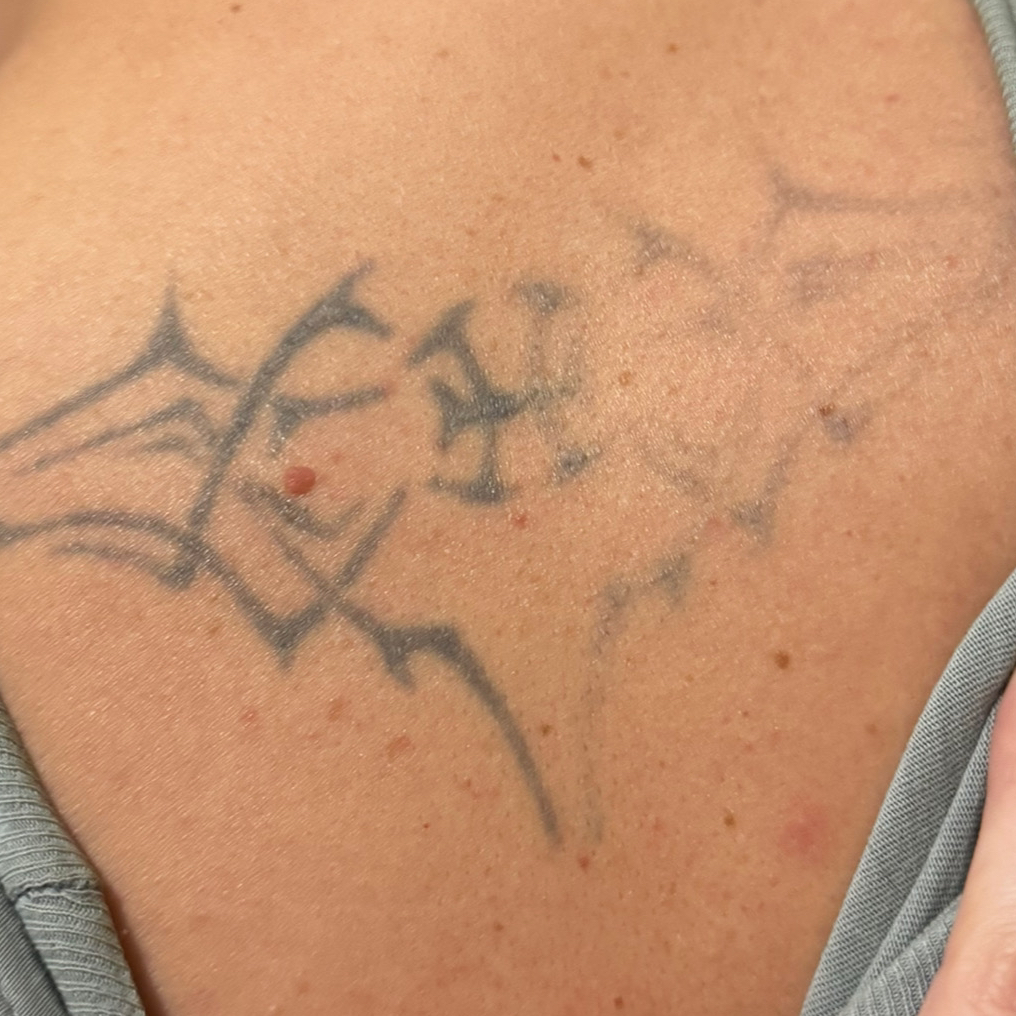 Лазерное сведение татуировки