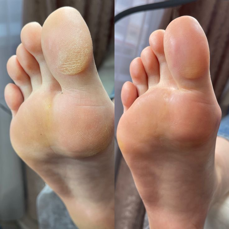 Полный педикюр с препаратами Kart + покрытие гель-лак