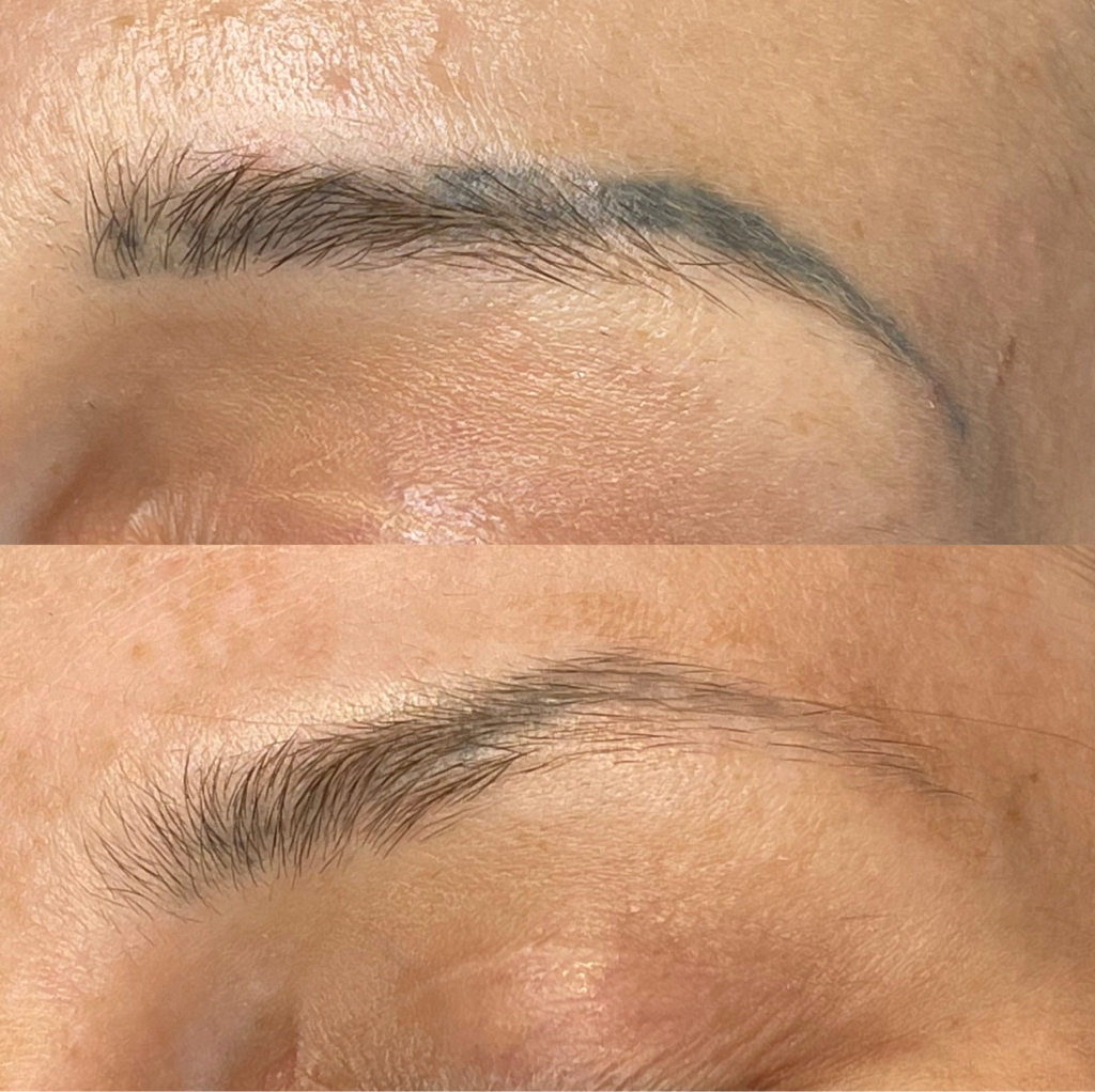 Лазерное удаление татуажа бровей