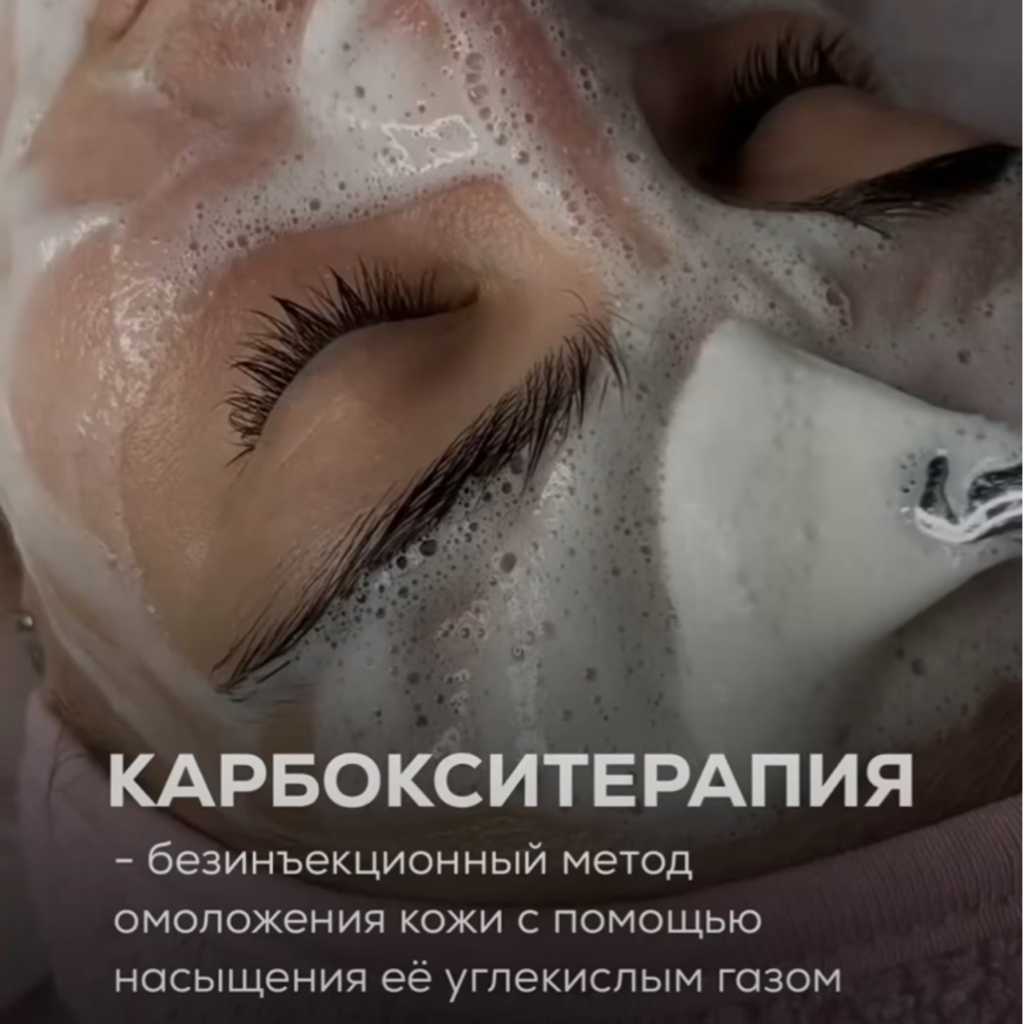 Карбокситерапия