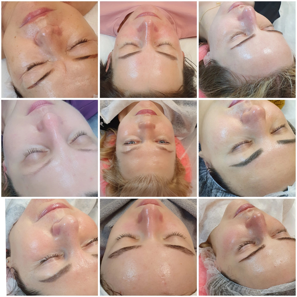 Профессионпльная комплексная чистка лица + пилинг+удаление комедонов (черные точки)+удаление поверхностных милиумов