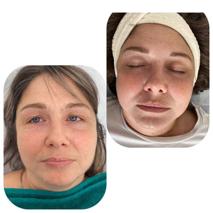 Омоложение без инъекций 20 процедур .10-RF-лифтинг +10 карбокситерапии