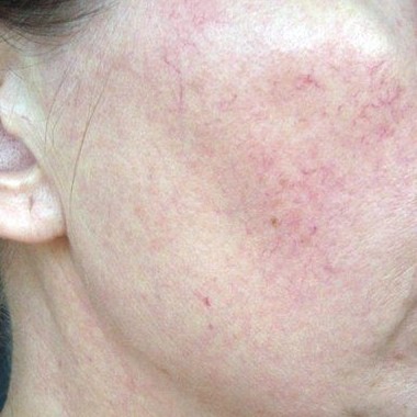 Лазерное Удаление 1 элемента ( капилляр/ сосудистая звездочка) 0,5 см2 цена 500₽