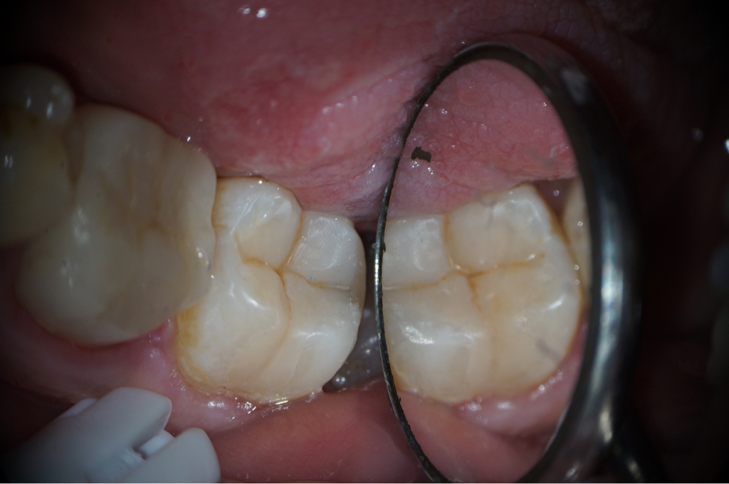 Лечение кариеса с постановкой световой пломбы (пр-во Япония)