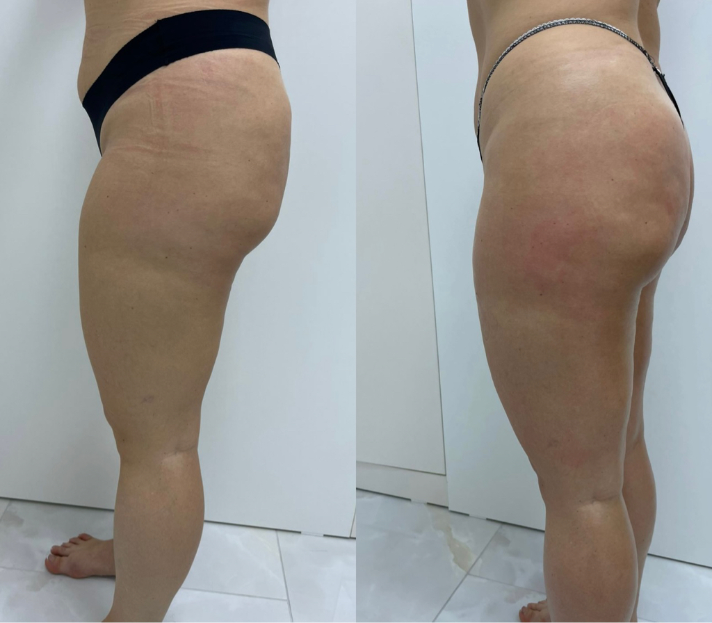 Женщины: 
V lift бедра