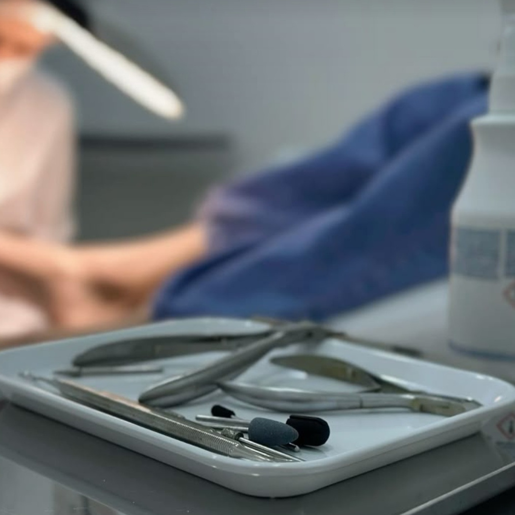 Удаление стержневой мозоли с установкой разгрузочной системы