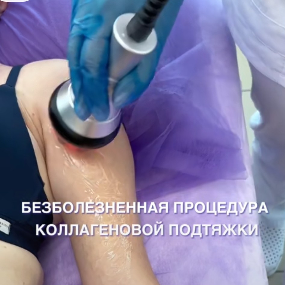 RF-лифтинг (руки)