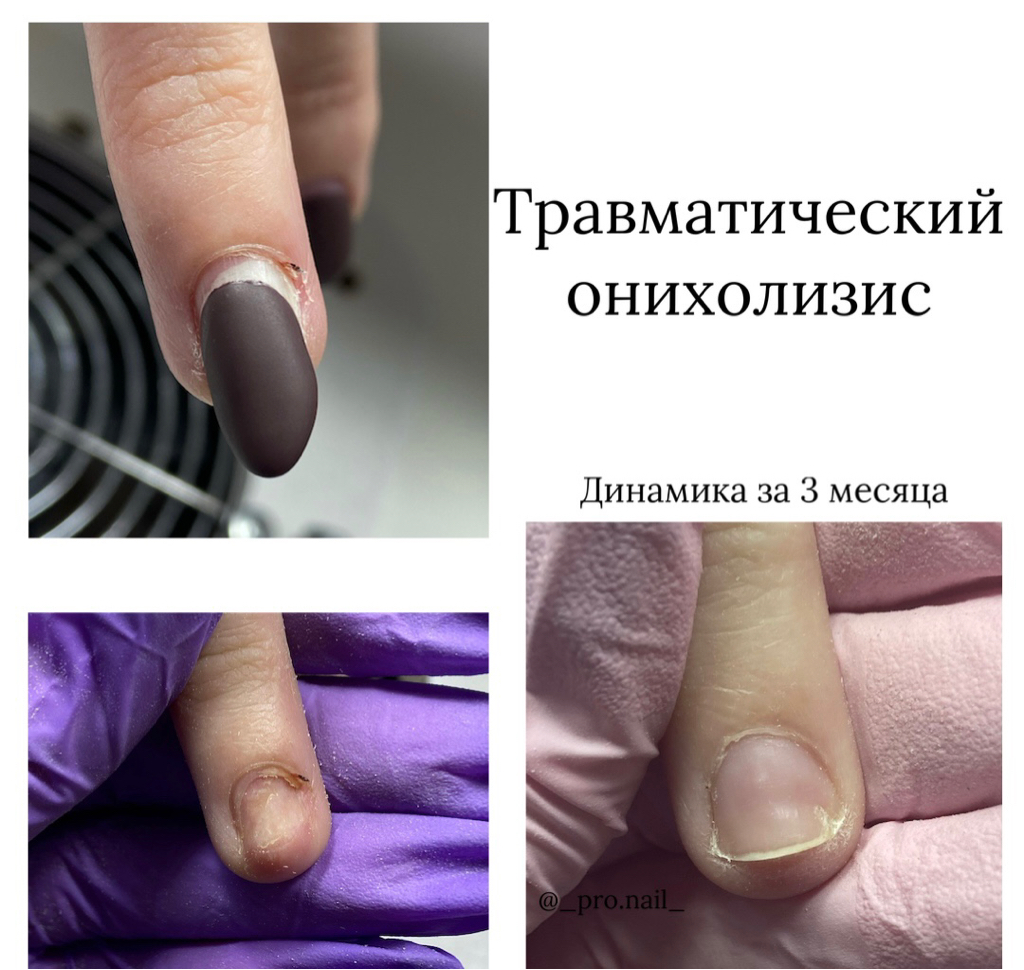 Маникюр подологический