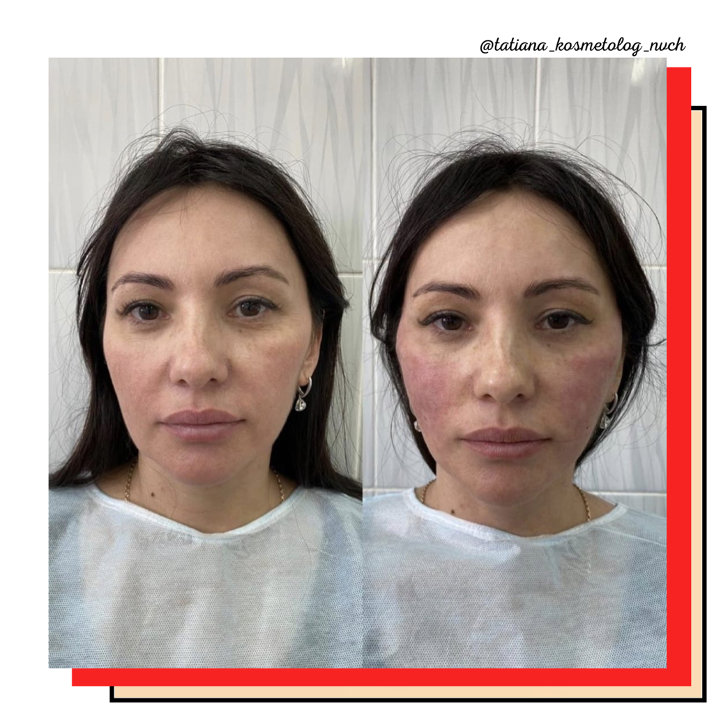 Контурная пластика