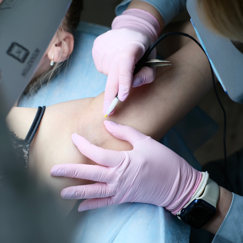 Электроэпиляция подмышек