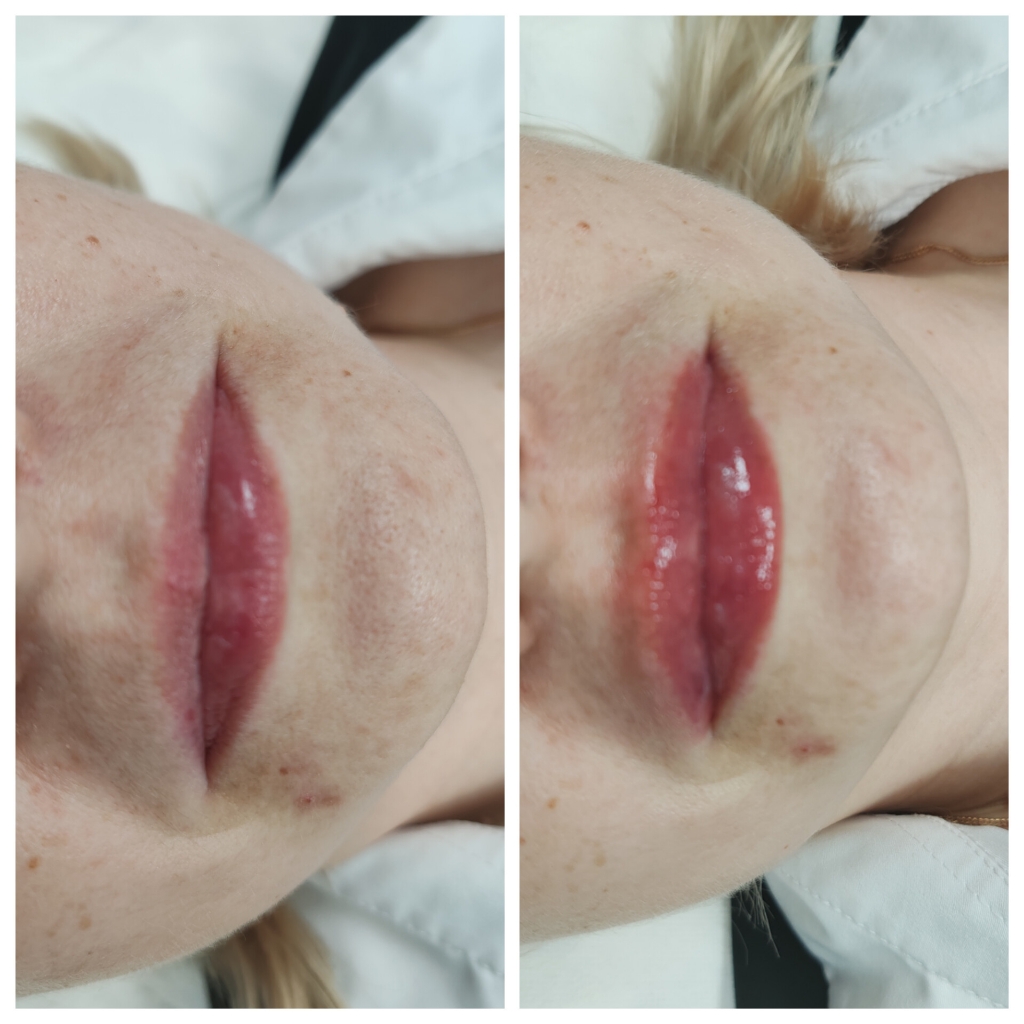 Аугментация губ (увеличение и увлажнение)