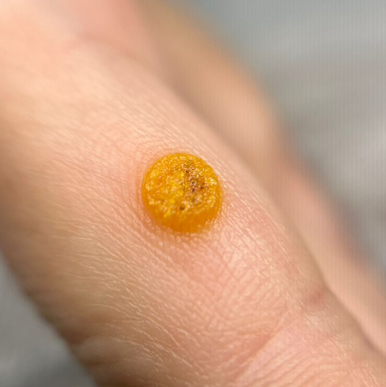 ОБРАБОТКА БОРОДАВКИ