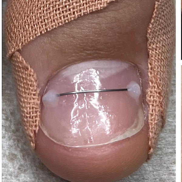 Установка коррекционной системы Титиновая нить