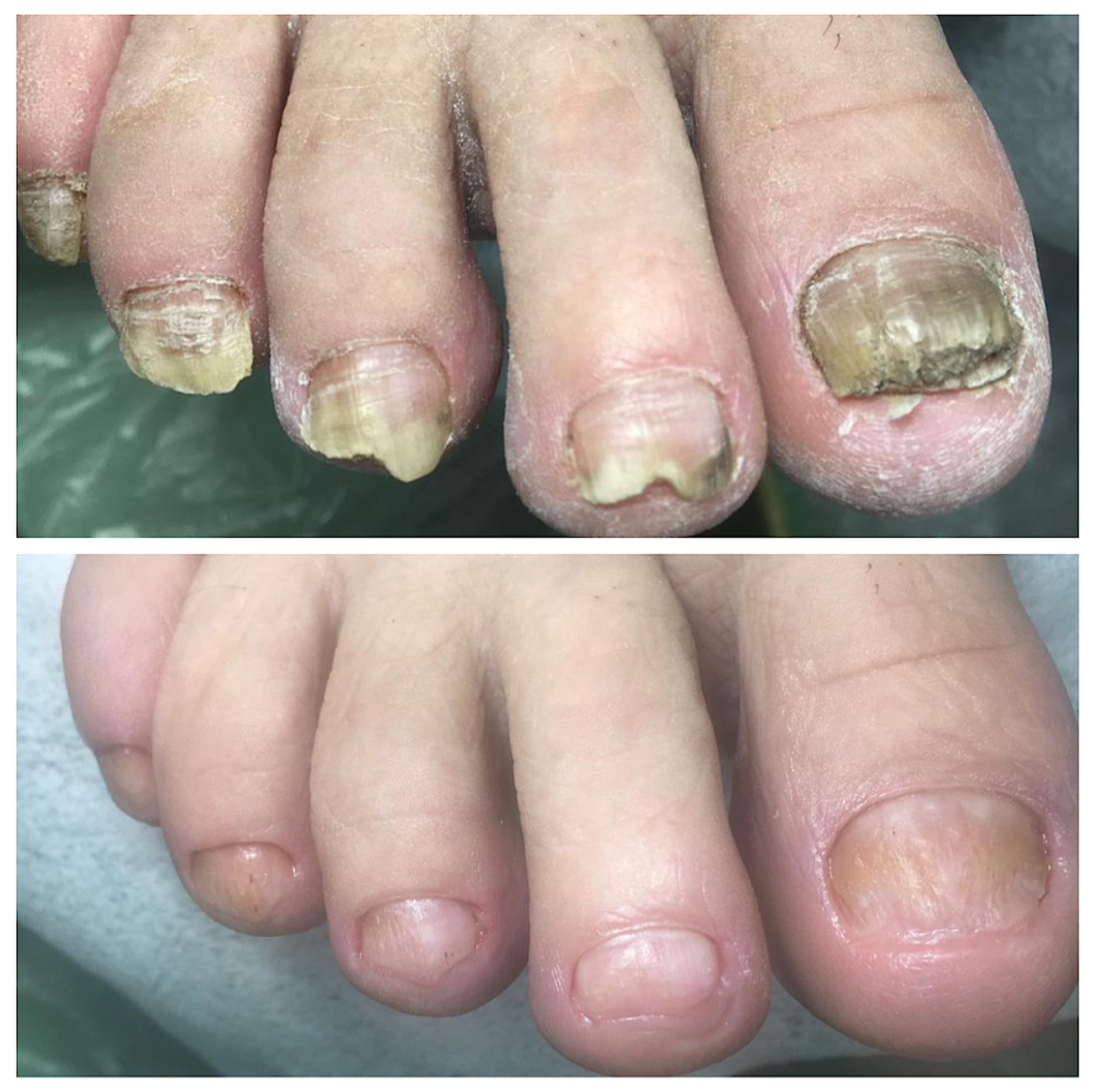 Обработка онихомикоза (грибок) ногтевой пластины на ногах