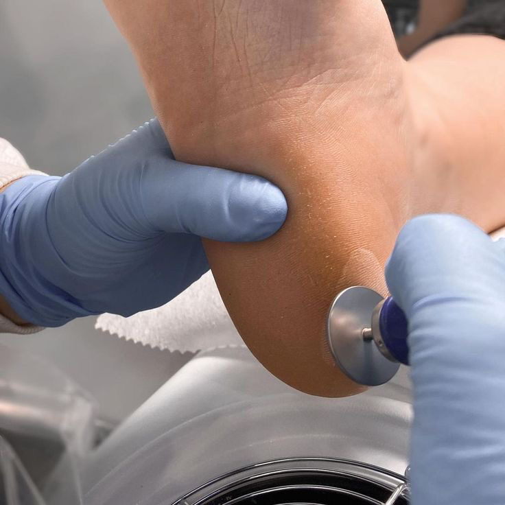 Обработка стоп( трещины)