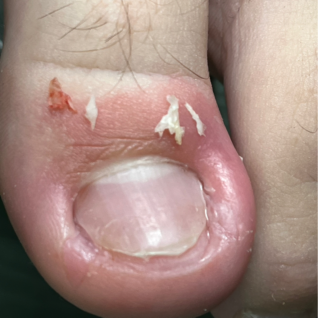 Работа с вросшим ногтем