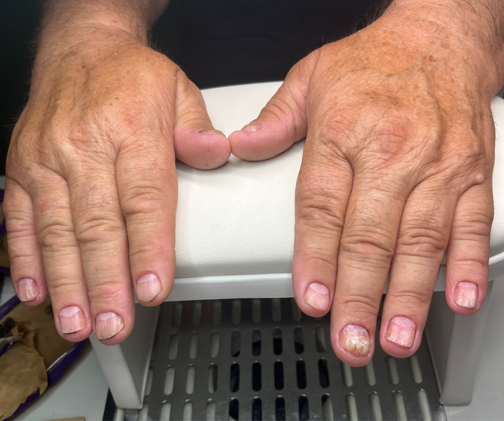 Маникюр с обработкой онихомикоза (грибка), онихолизиса (пустоты) или АД, псириаза, экземы