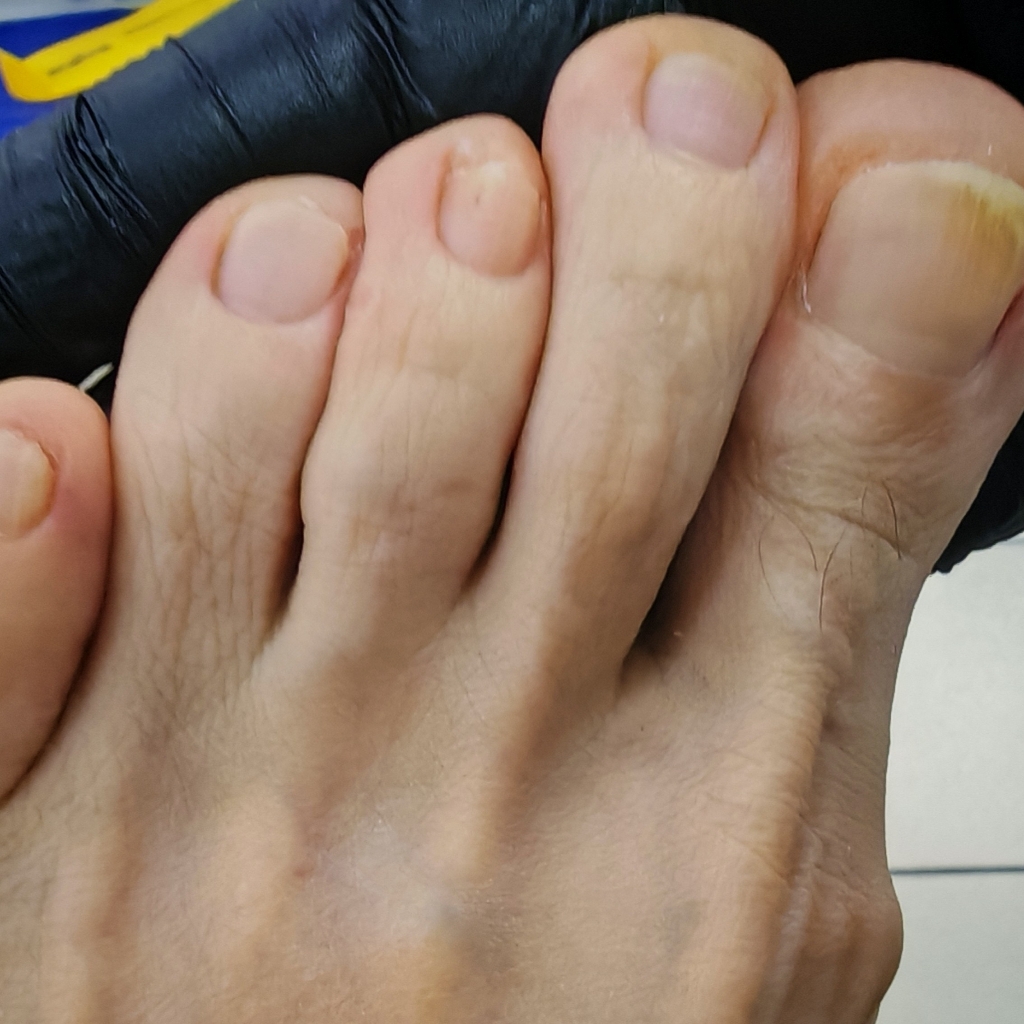 Обработка ногтей на ногах.