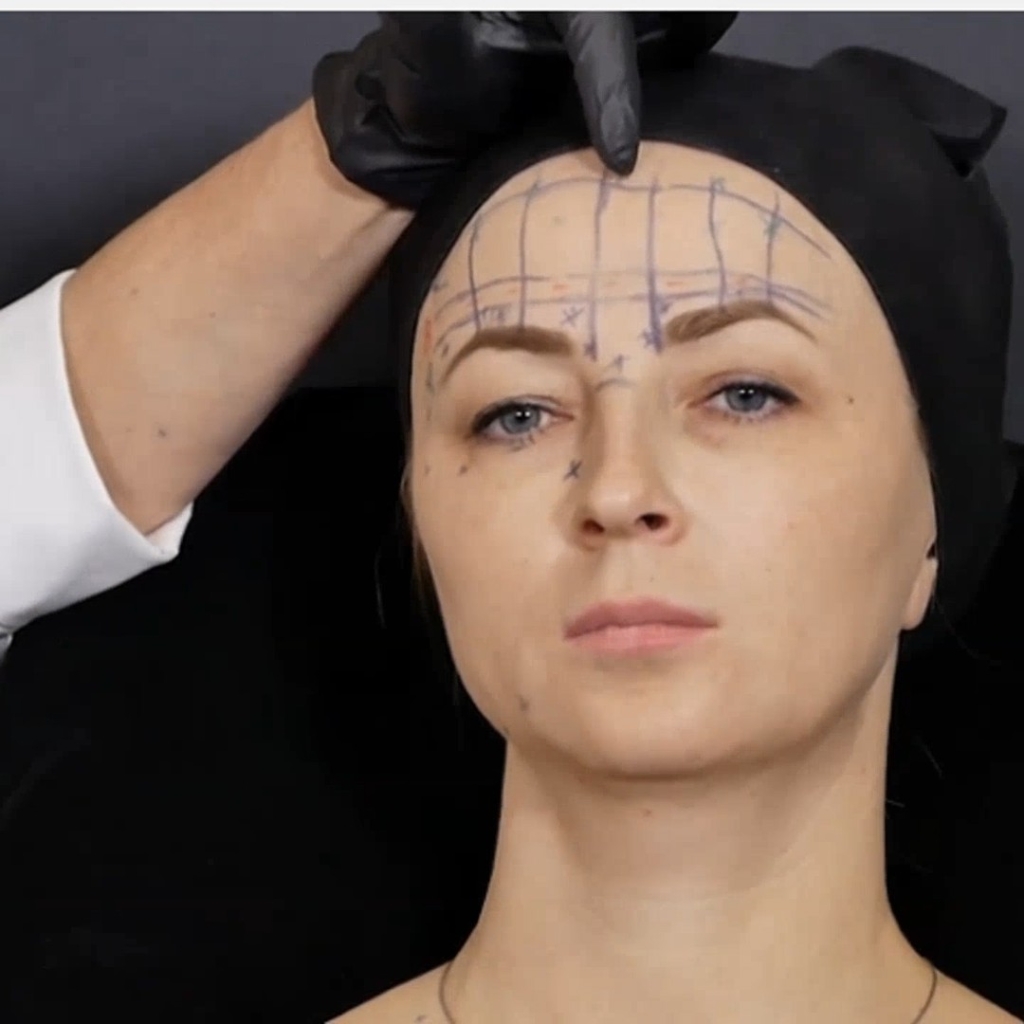 Ботулинотерапия 