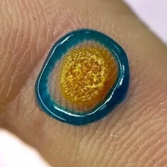 Удаление мозоли|натоптыша|бородавки до 10 мм азотной кислотой 1 единица