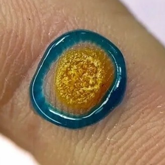 Удаление мозоли|натоптыша|бородавки 10 - 20 мм азотной кислотой 1 единица