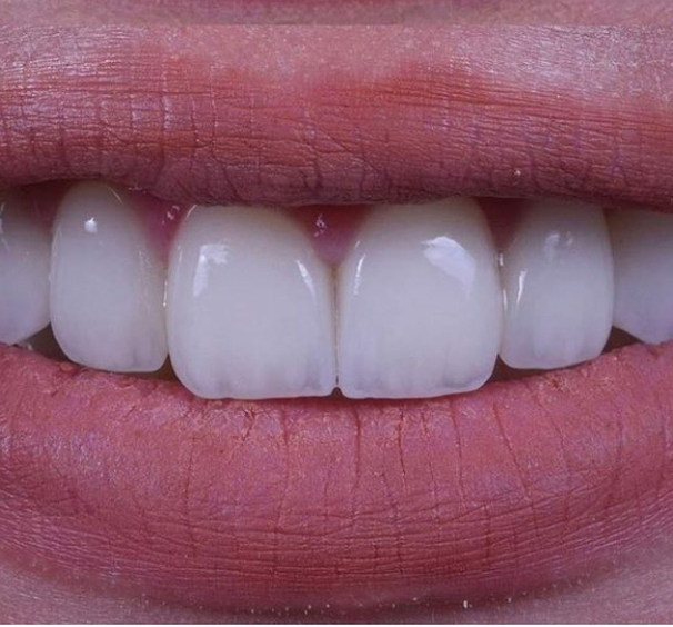 Винир целькерамический