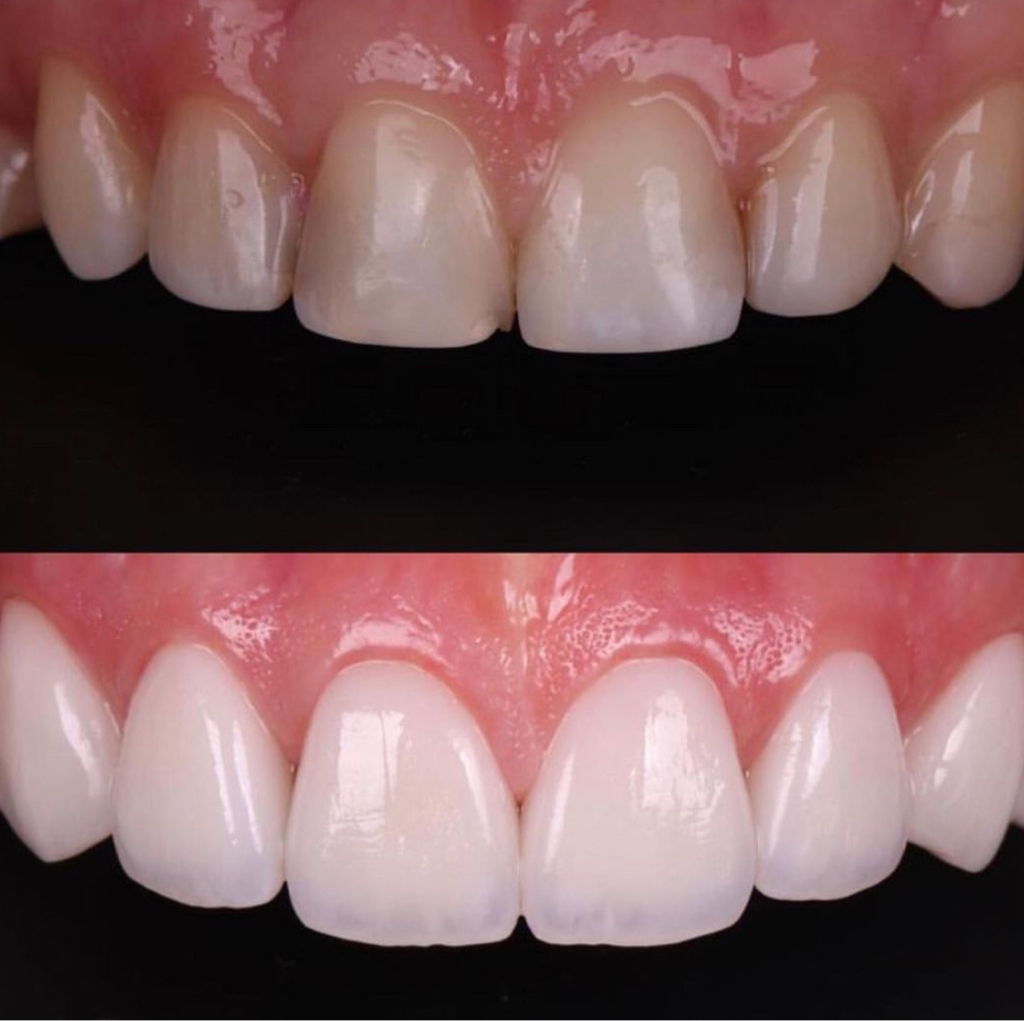 Винир на рефракторе, изготовление - премиальная лаборатория, г.Москва