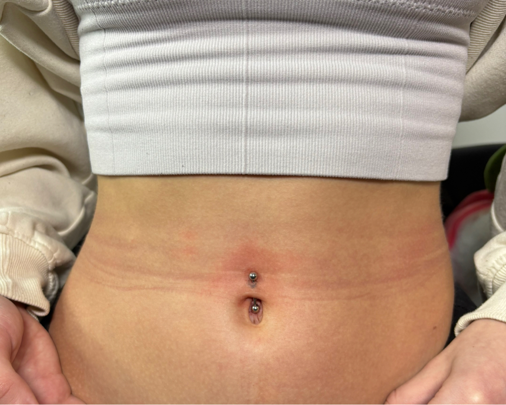 Прокол пупка