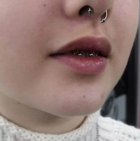 Прокол септум