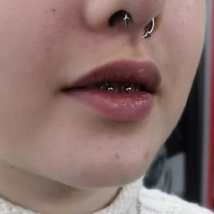 Прокол уздечки (смайл)