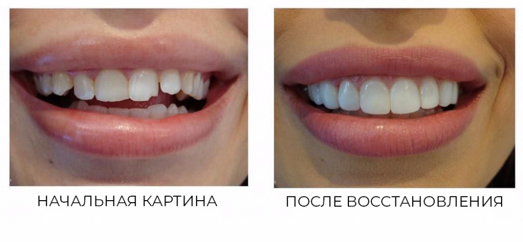 Композиционный винир(1 шт)