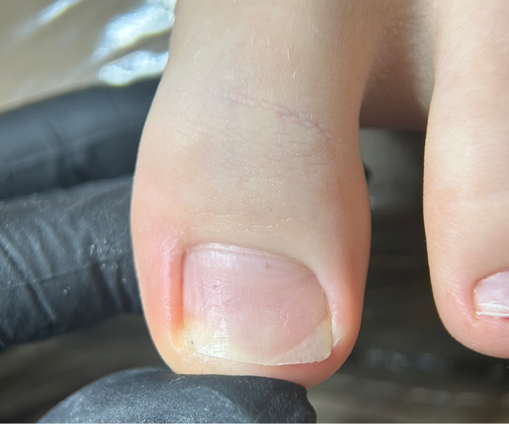 Снятие коррекционной системы