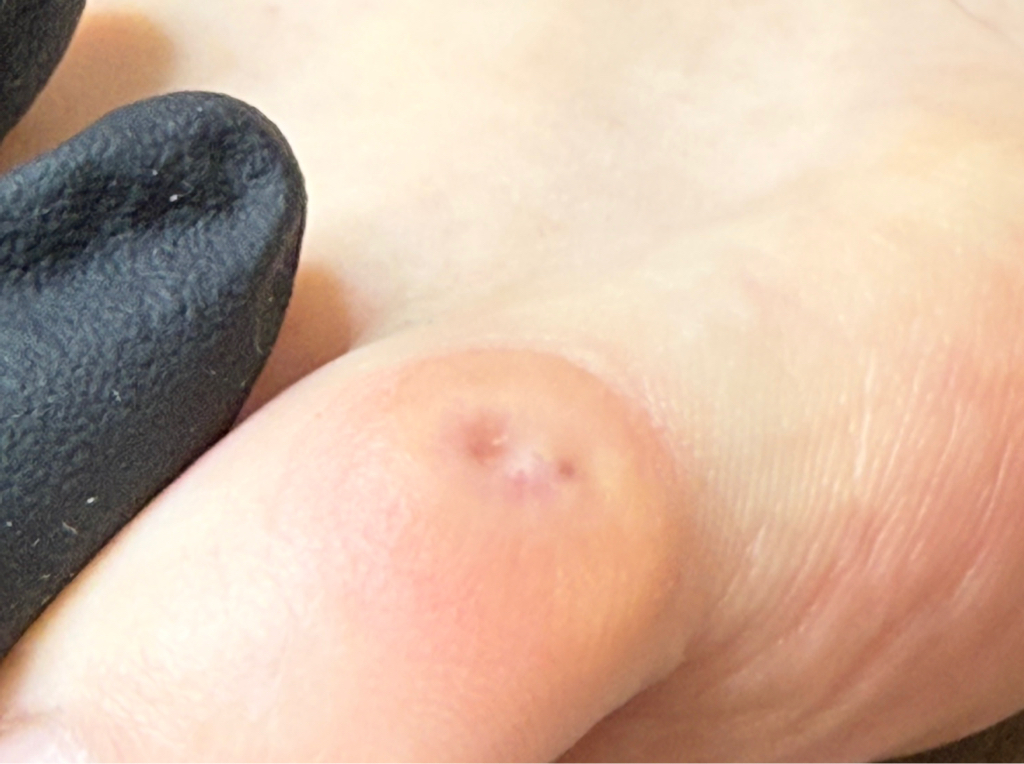 Обработка стержневой мозоли