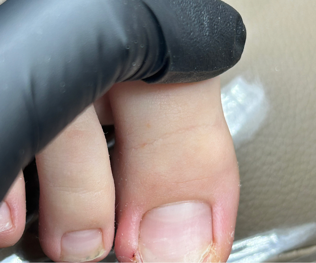 Комплексная работа с вросшим ногтем