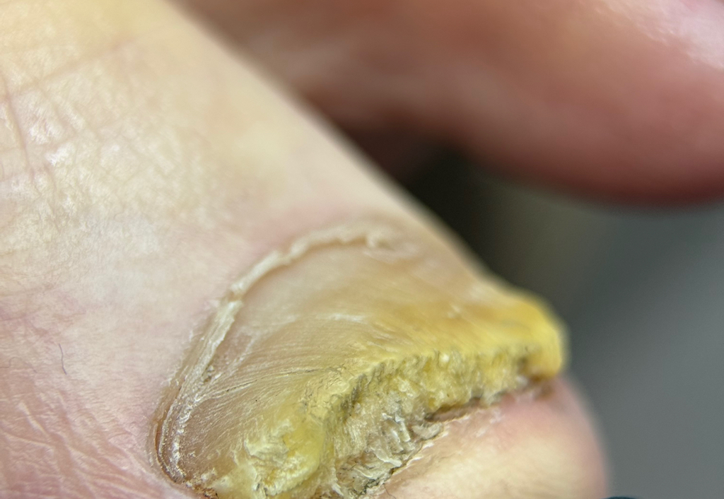 Педикюр повышенной сложности