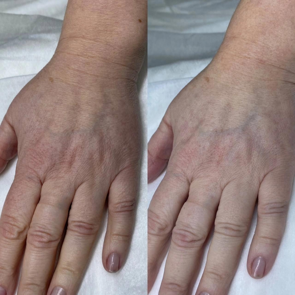 Омоложение (подтяжка) кисти рук