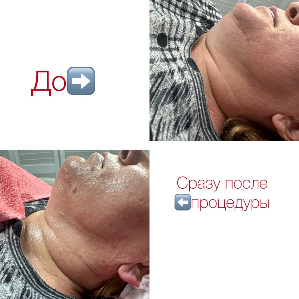 Омоложение (подтяжка) второй подбородок.