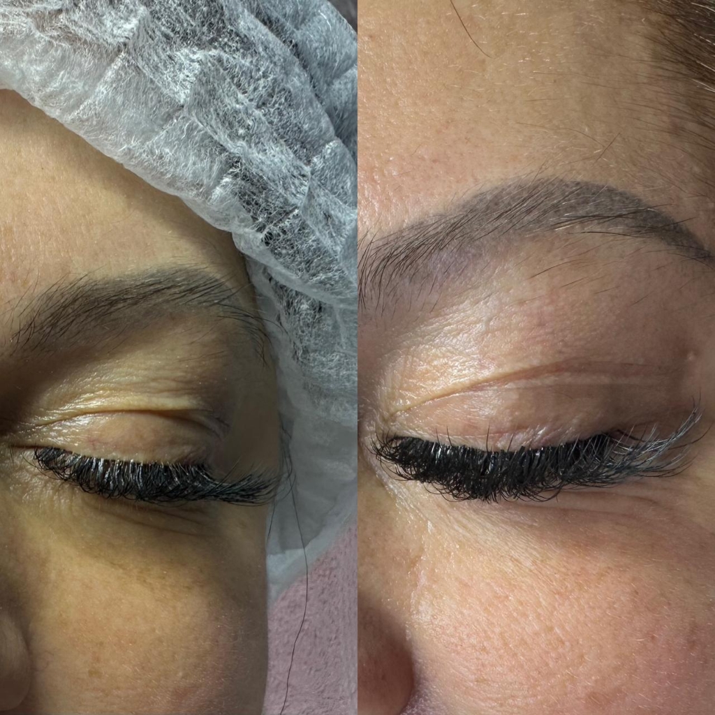 Омоложение (подтяжка) глаз