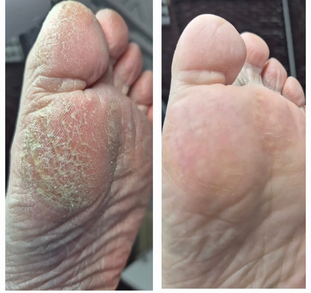 Обработка стопы