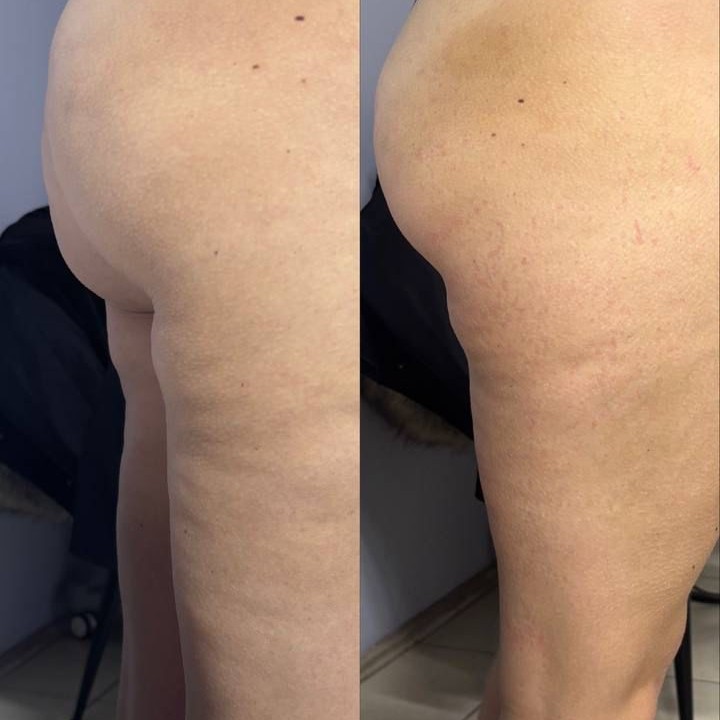 Омоложение (подтяжка) ног