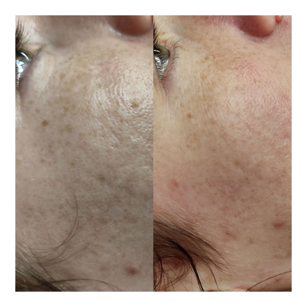 Лечение пигментных пятен (зависит от размера)