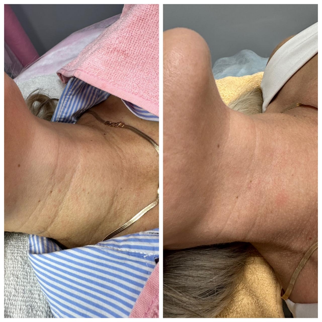 Омоложение, подтяжка шеи (кольца Венеры,подбородок)