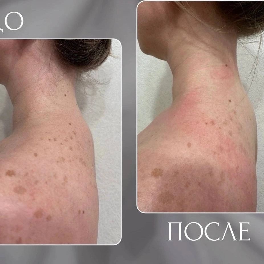 Вдовий горбик