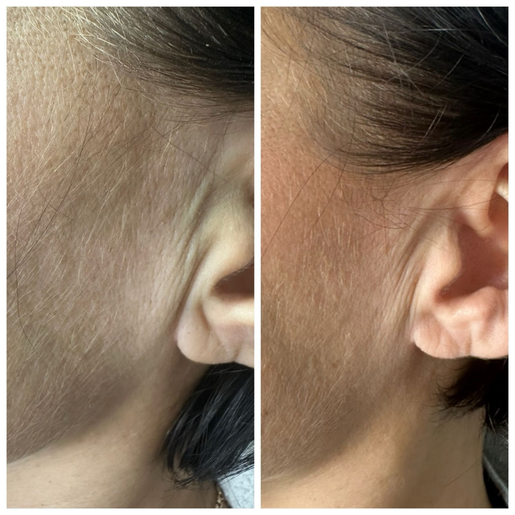 Омоложение, подтяжка околоушных морщин