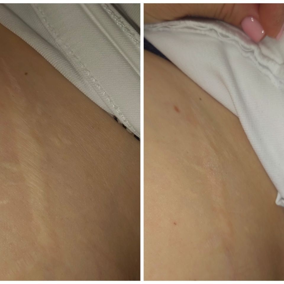 Лечение шрамов (зависит от размера)