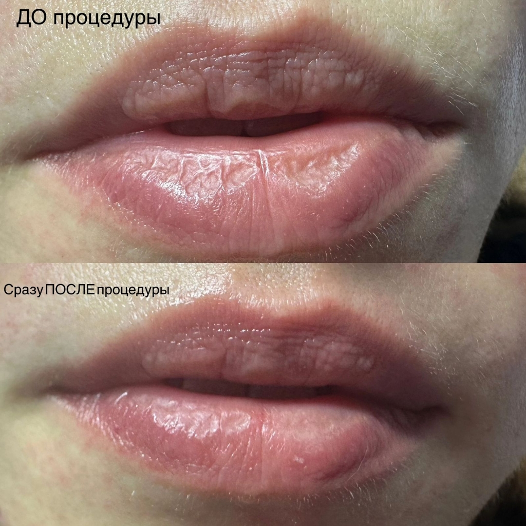 Омоложение губ
