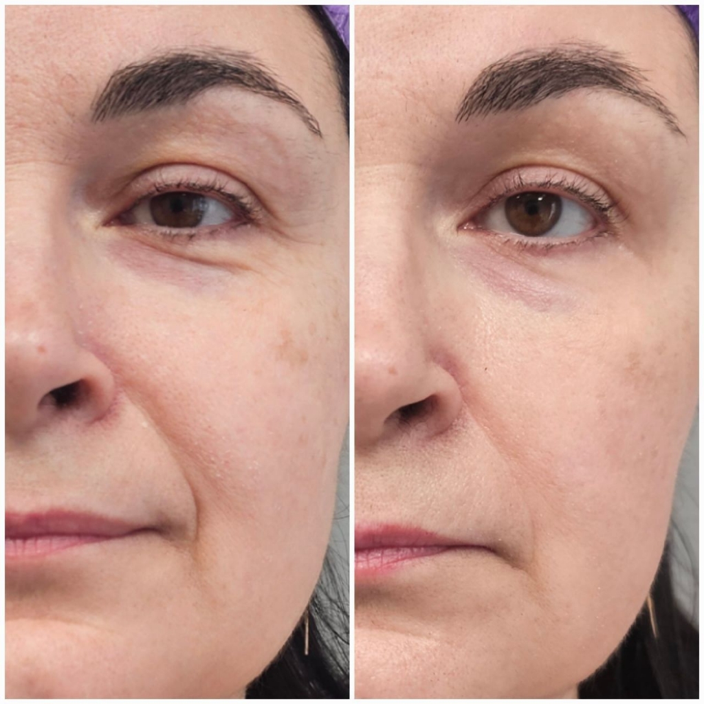 Омоложение лица (подтяжка)