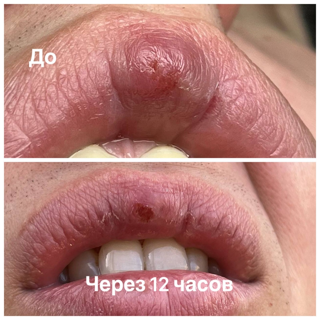 Лечение герпеса, незаживающие раны,синяки, суставная боль (зависит от размера проблемы)