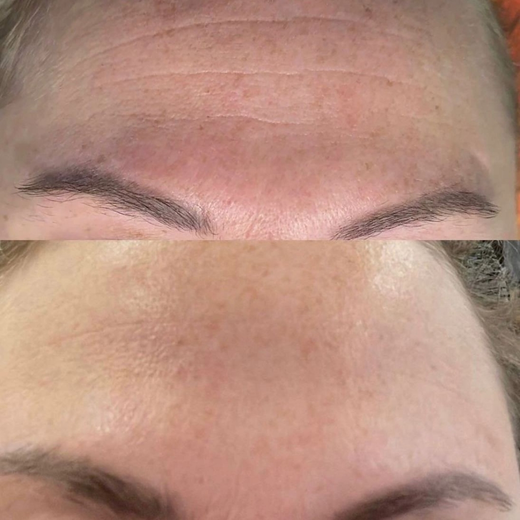 Омоложение (подтяжка) лба