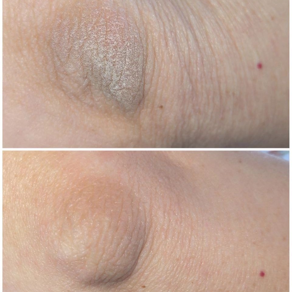 Омоложение (подтяжка) локти